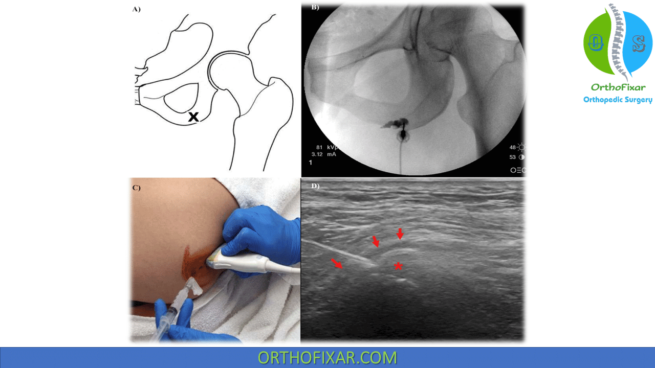 Ischial Bursitis Injection Easy Tutorial Orthofixar 2024 7177