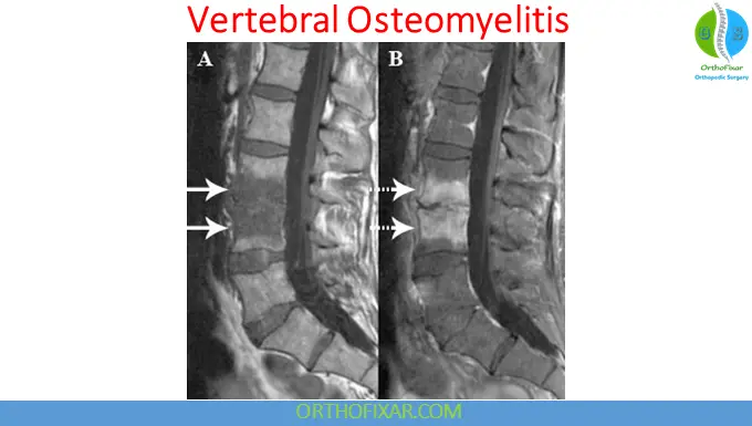Osteomyelitis: Causes, Symptoms, Diagnosis & Treatment 4 Vertebral Osteomyelitis