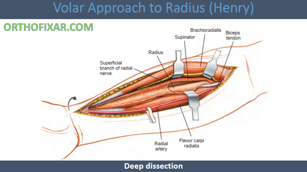 Volar Approach to Radius (Henry approach)
