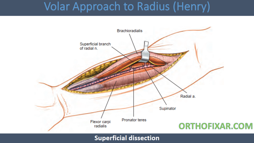 Volar Approach to Radius (Henry approach)