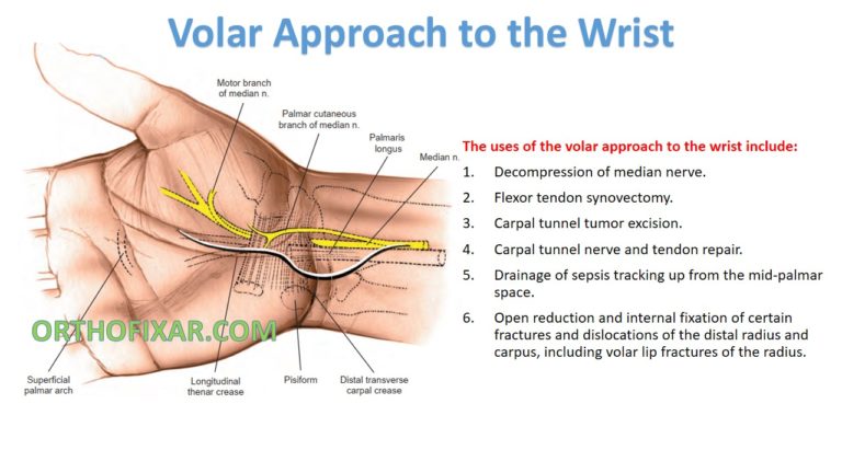 Volar Approach to the Wrist
