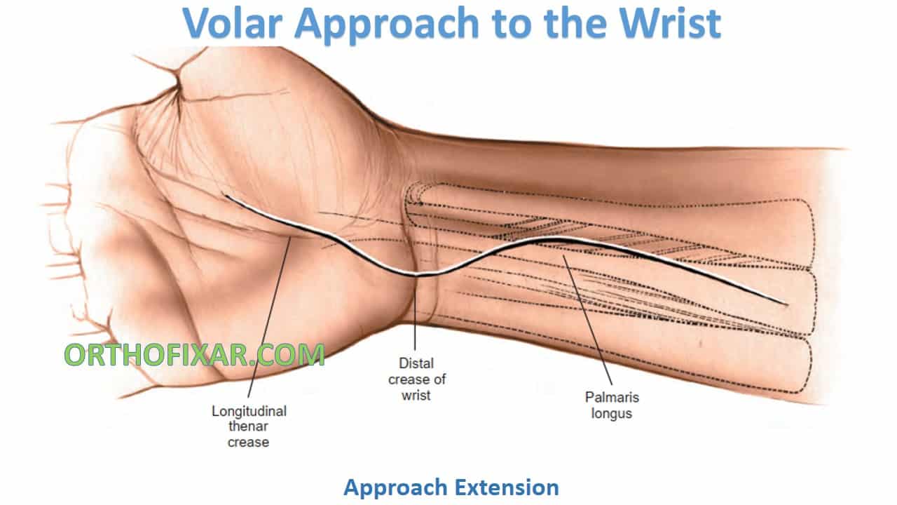 Volar Approach To The Wrist OrthoFixar 2024