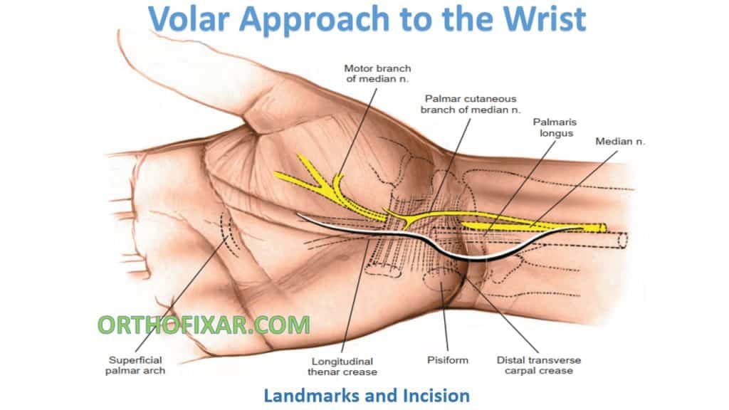Volar Approach to the Wrist