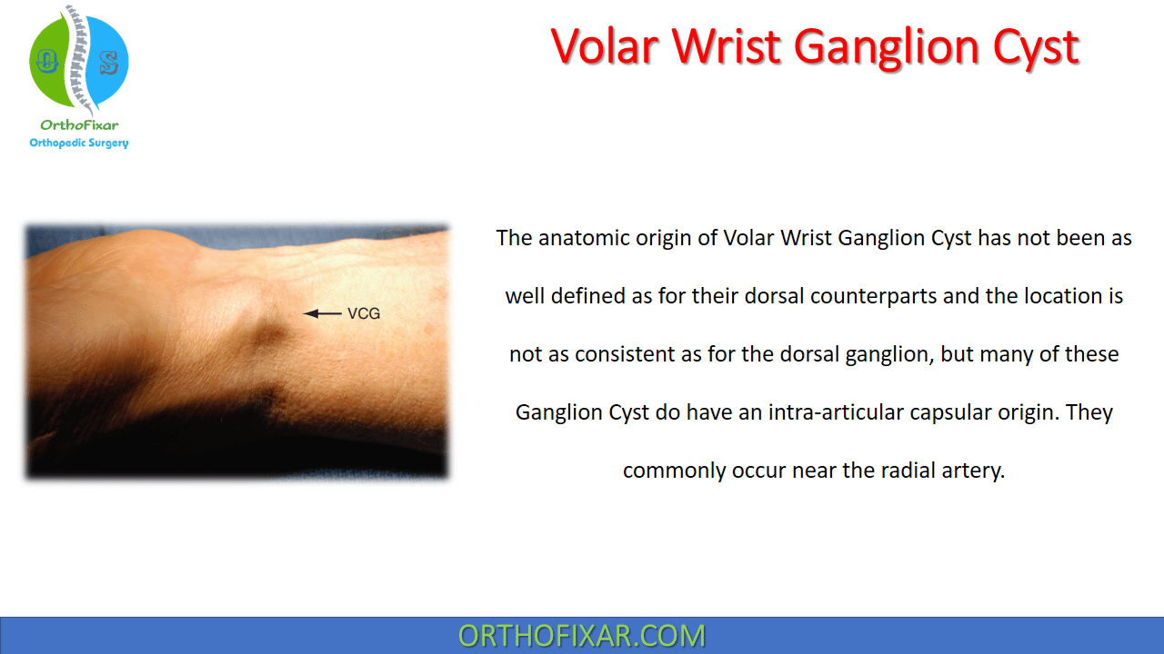 Volar Wrist Ganglion Cyst