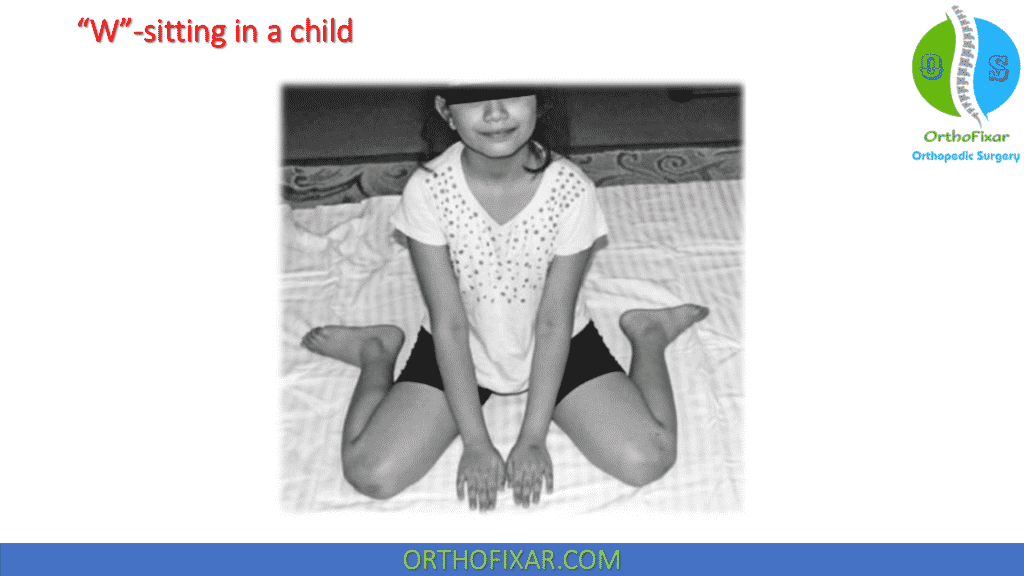 “W”-sitting in a child