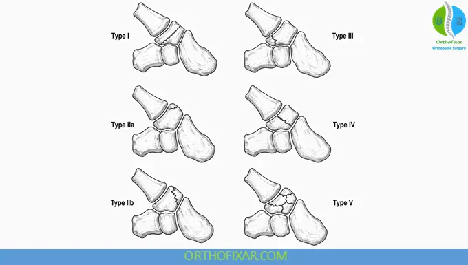 Walker's Classification for Trapezium Fracture