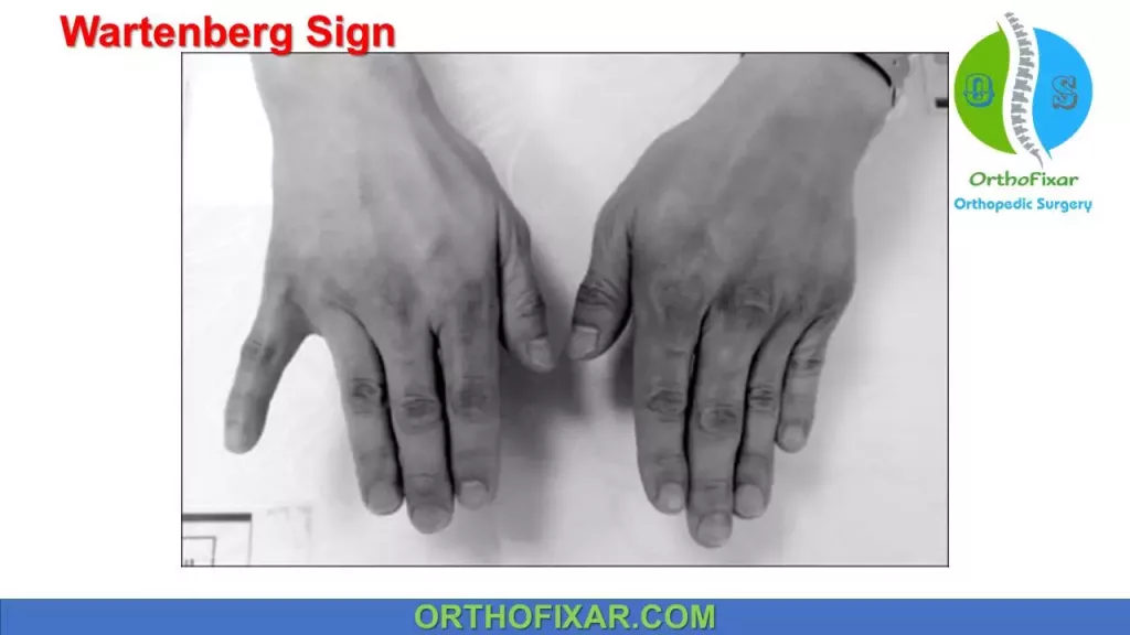 Wartenberg Sign Ulnar Nerve Weakness Guide Wartenberg Sign Ulnar Nerve Weakness Guide