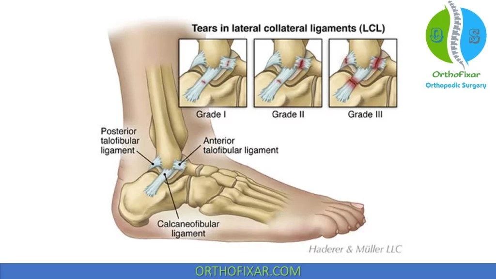 Lateral Ankle Sprain | OrthoFixar 2024