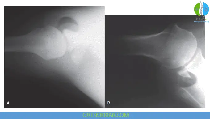 Shoulder X-ray Views 6 West Point view of the glenohumeral joint