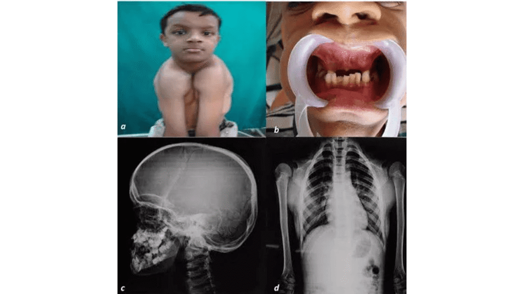 Cleidocranial Dysplasia: Causes, Symptoms & Treatment 4 What Is Cleidocranial Dysplasia