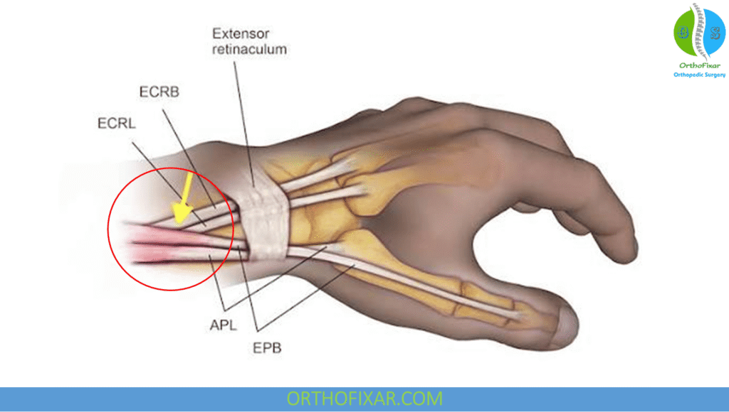 Intersection Syndrome: Dorsal Wrist Pain Causes & Treatment 5 What Is Intersection Syndrome