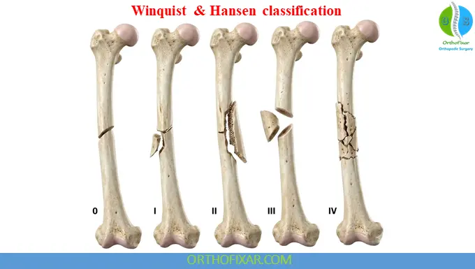 Winquist and Hansen Classification Femoral Shaft Fracture
