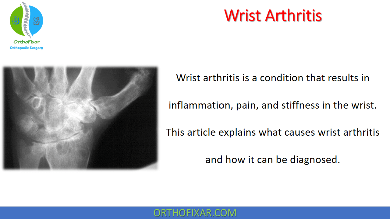  Wrist Arthritis 