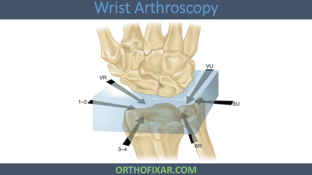 Wrist Arthroscopy 2