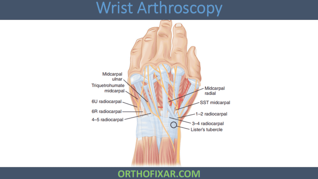 Wrist Arthroscopy Portals
