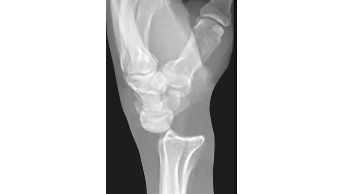 Wrist Dislocation xray