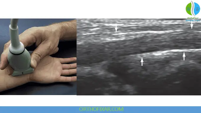 Wrist Ultrasound Imaging - Longitudinal view of carpal tunnel