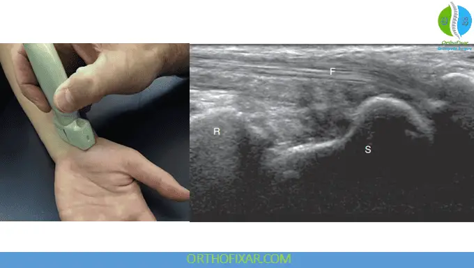 Wrist Ultrasound Imaging - Longitudinal view of the radial side of the anterior surface of the wrist