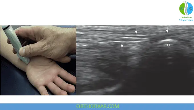 Wrist Ultrasound Imaging - Longitudinal view of ulnar side of wrist over hook of hamate