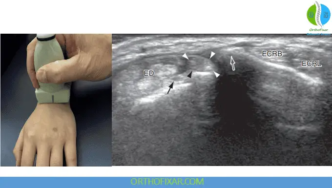 Wrist Ultrasound Imaging - Transverse view of dorsal proximal wrist