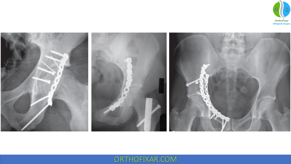 Acetabulum Fracture Full Explained | OrthoFixar 2025