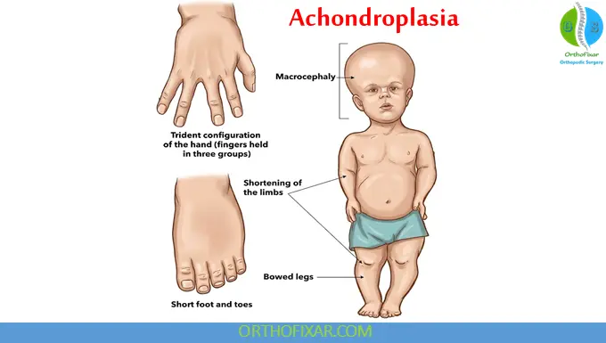 achondroplasia dwarfism