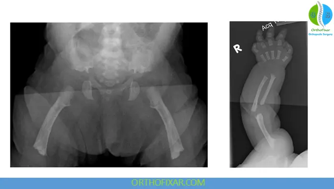 achondroplasia imaging xray