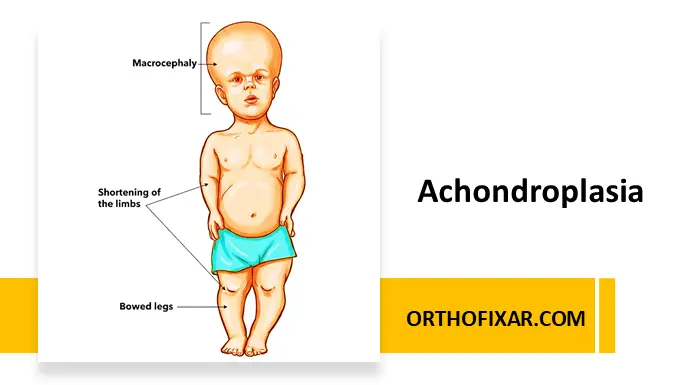 achondroplasia