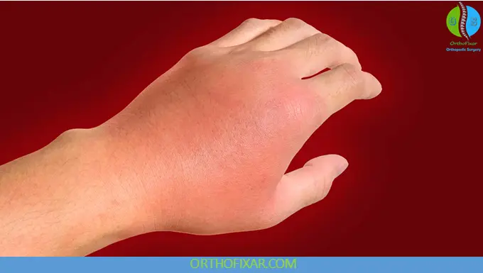 acute Cellulitis in the hand