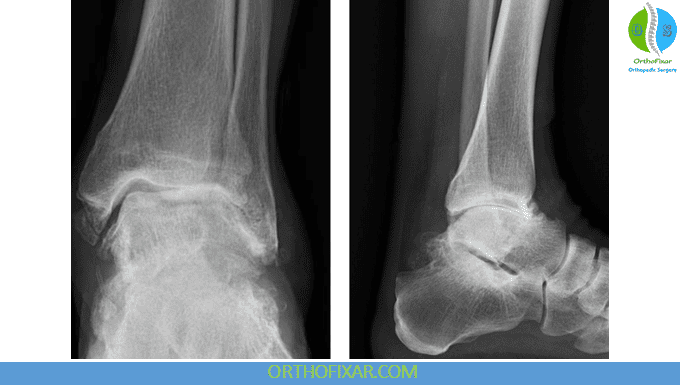 advanced ankle arthritis