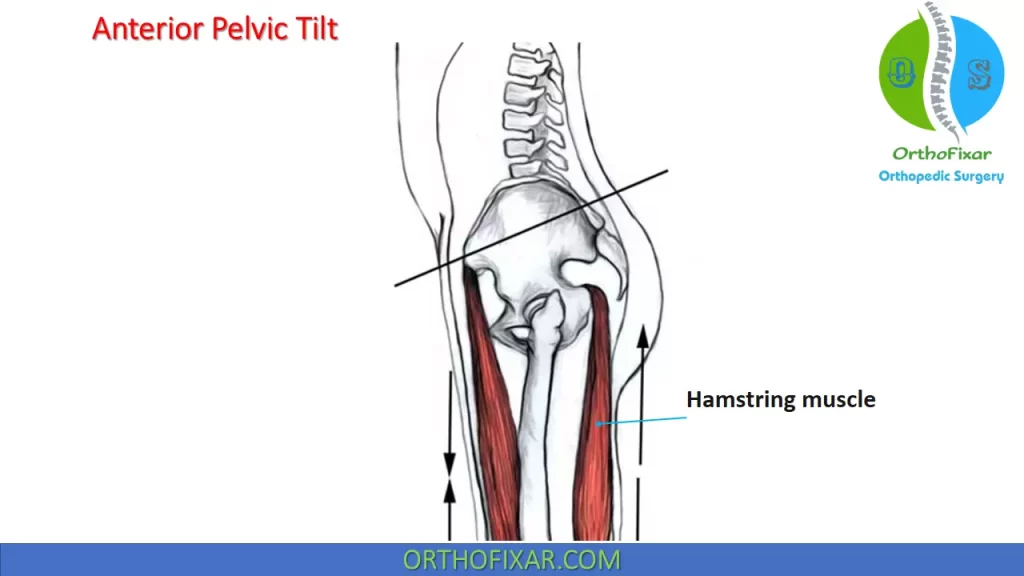 affects of anterior pelvic tilt on Hamstring muscles