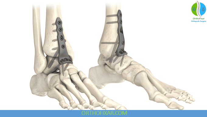 Ankle Fusion: Procedure, Recovery, Benefits & Limitations 4 ankle fusion diagram