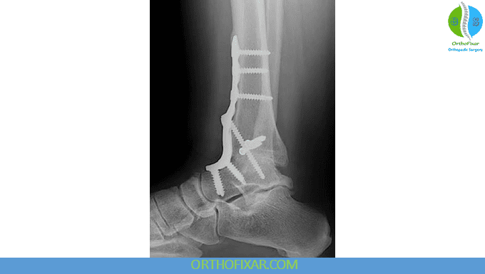 Ankle Fusion: Procedure, Recovery, Benefits & Limitations 5 ankle fusion xray