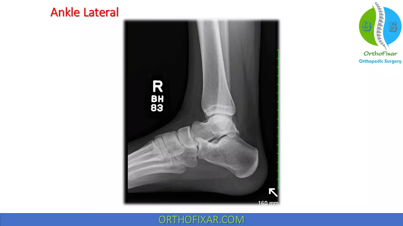 ankle lateral view