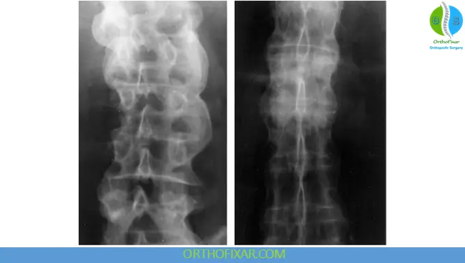 ankylosing spondylitis Bamboo spine appearance