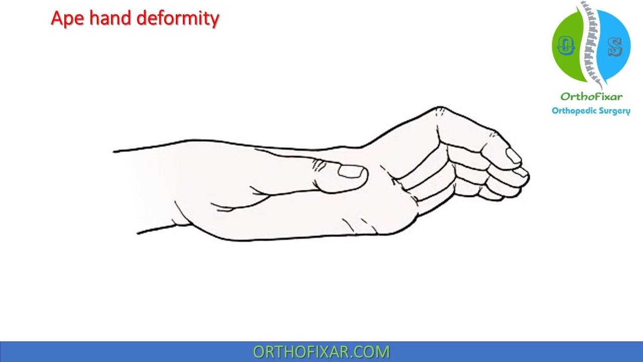 ape hand deformity