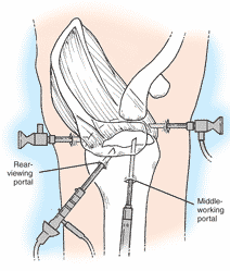 arthroscopic approach to the shoulder