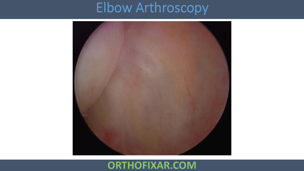 Elbow Arthroscopy: Indications, Techniques, Portal Placement ...
