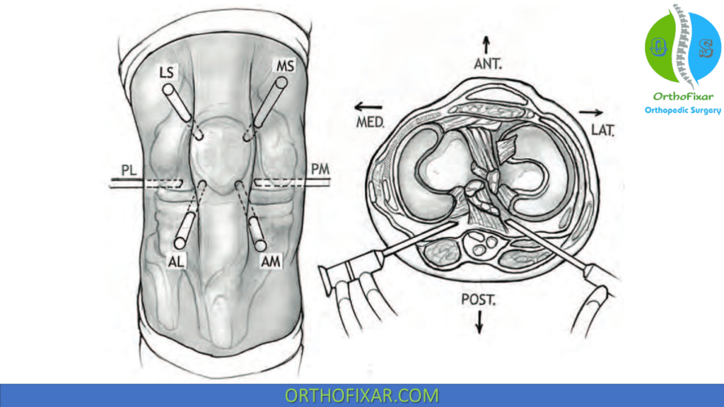 Arthroscopic Knee Synovectomy 3 arthroscopic portals used in a complete arthroscopic synovectomy