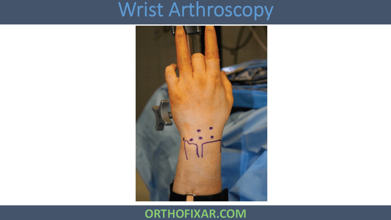 Wrist Arthroscopy Easy Tutorial Orthofixar