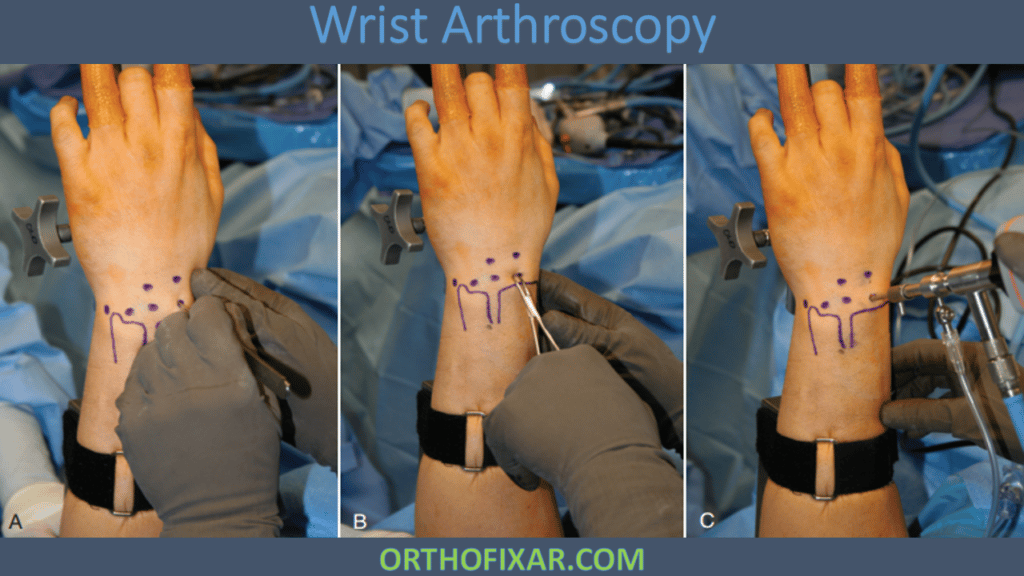 arthroscopic wrist surgery (2)