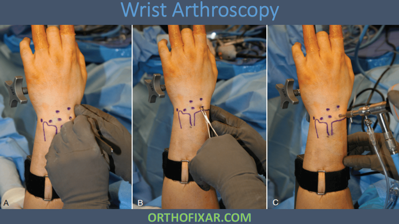 Arthroscopy And Endoscopy Of The Elbow Wrist And Hand Surgical Anatomy ...