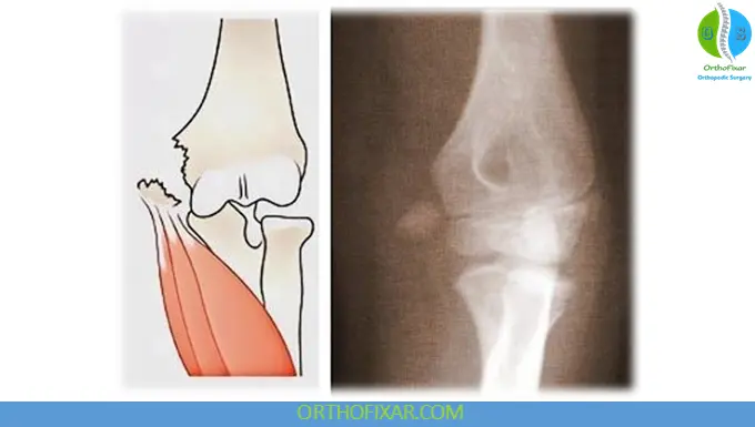 avulsion Medial Epicondyle Fracture