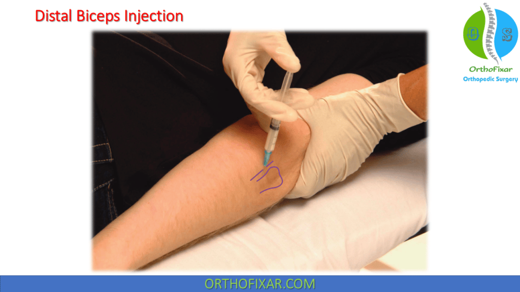 bicep steroid injection