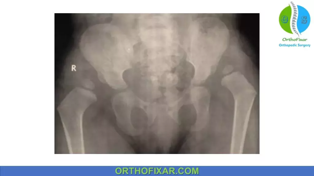 Bilateral Developmental dysplasia of the hip