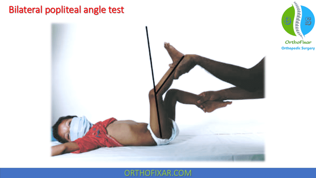 bilateral popliteal angle test