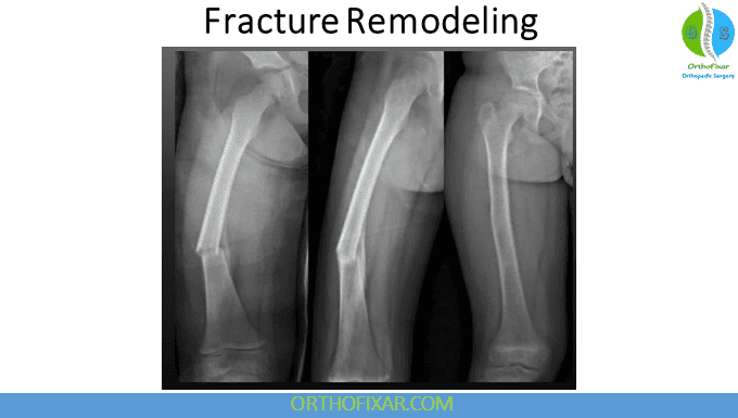 bone Remodeling