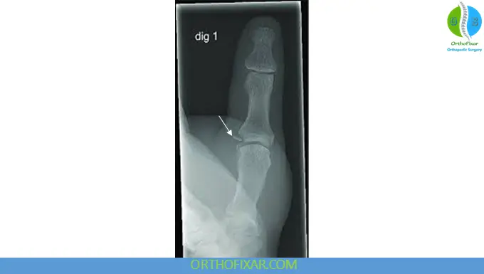 bony avulsion Skier’s Thumb
