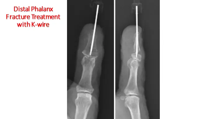 broken distal phalanx treatment - k-wire