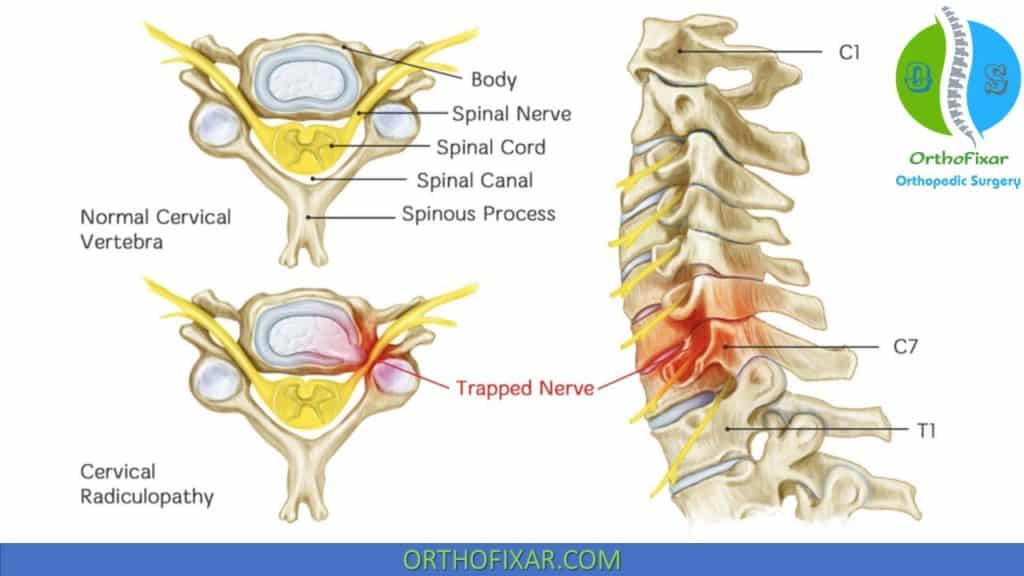 cervical spine radiculopathy
